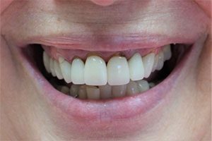 Smile 2 before