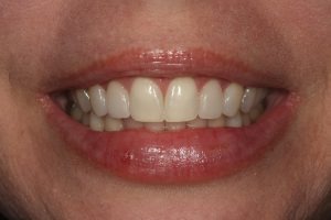 Smile After